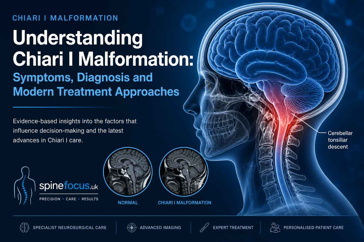 Understanding Chiari I Malformation: Symptoms, Diagnosis, and Modern Treatment Approaches