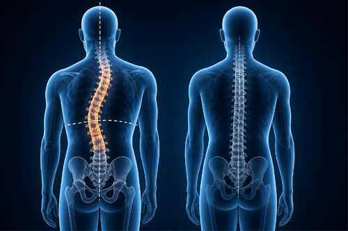 Adult spinal deformities